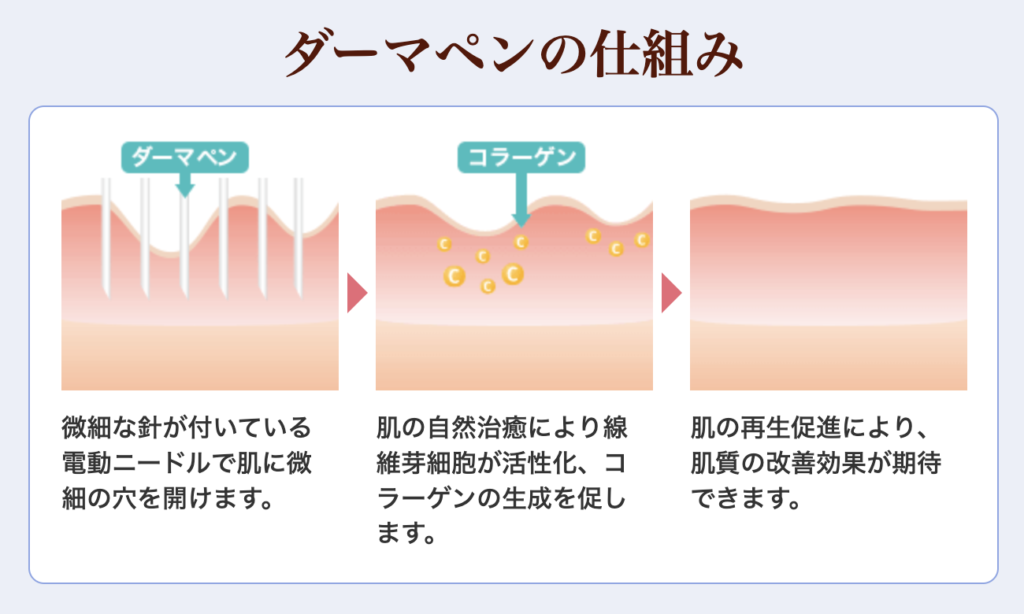 ダーマペンの仕組み 品川美容外科