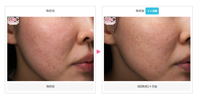 湘南美容クリニック 千葉 ダーマペン症例写真
