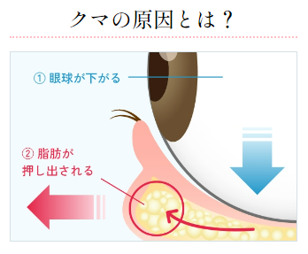 NALU Beauty Clinic　目の下のクマ取り