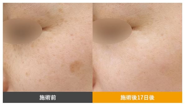 湘南美容クリニック シミ取り