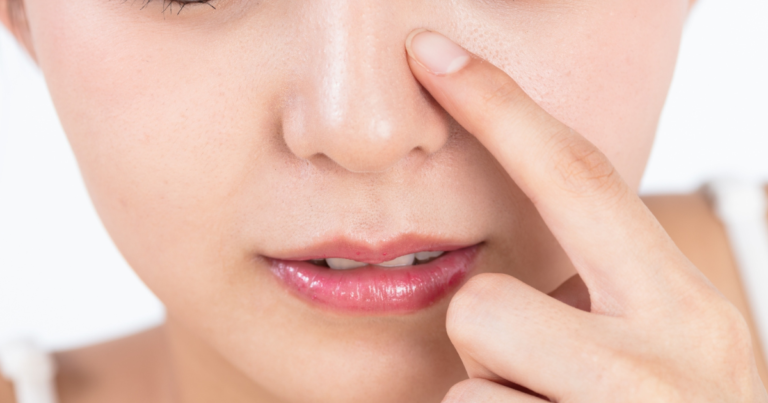 いちご鼻治療が安いおすすめの美容皮膚科9選｜おすすめの治療法も解説