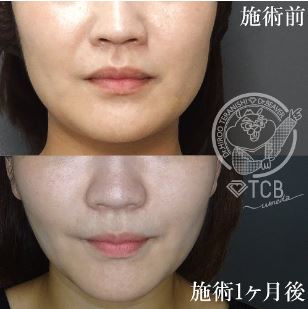 TCB東京中央美容外科 エラボトックス 症例