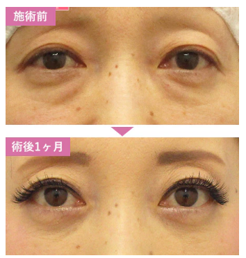 湘南美容クリニック　クマ取り