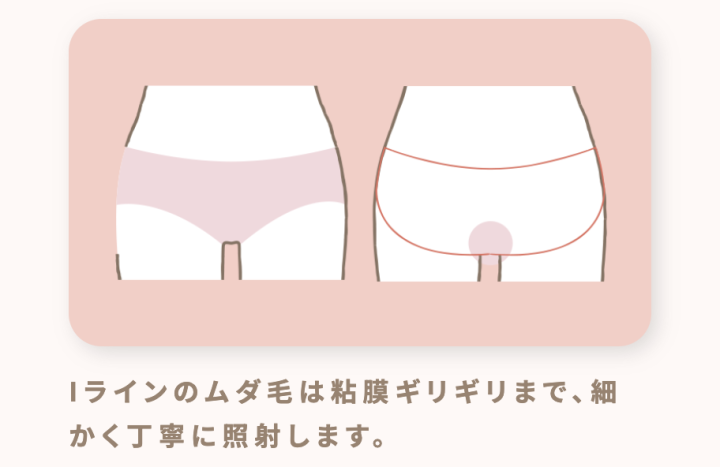 ルシアクリニック 名古屋 VIO脱毛