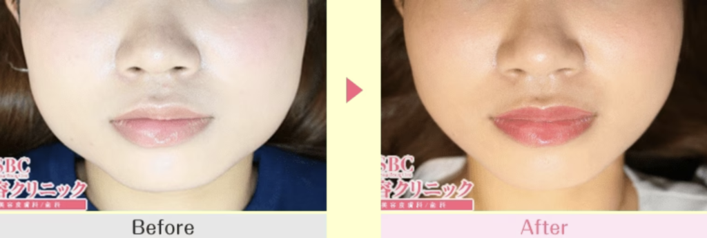 湘南美容クリニック　エラボトックス