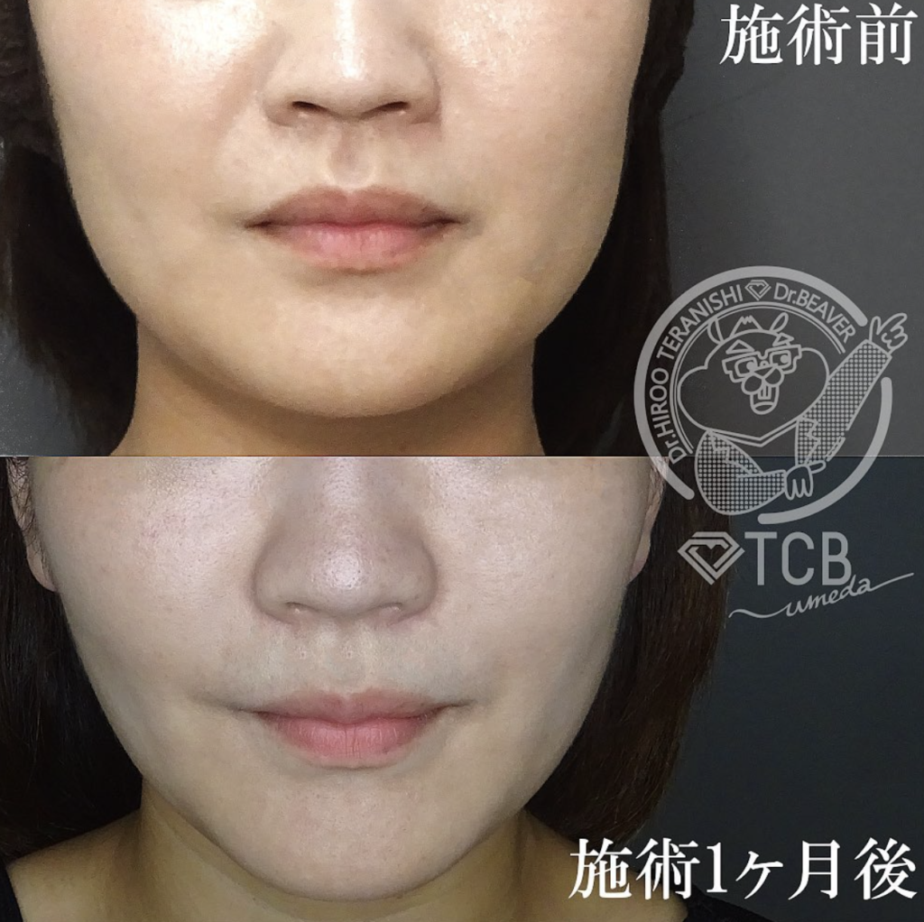 TCB東京中央美容外科 エラボトックス