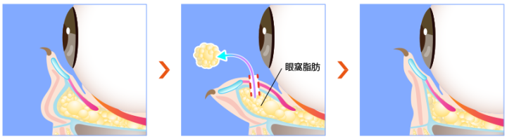 TCB東京中央美容外科　目の下のクマ取り