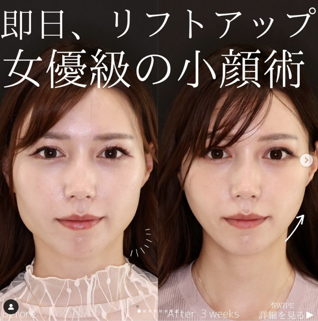 TAクリニック エラボトックス