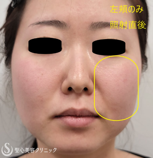 聖心美容クリニックのポテンツァダイヤモンドチップ施術の症例画像