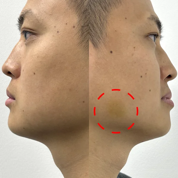 エラボトックス 症例写真