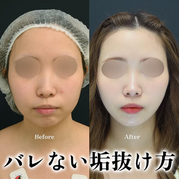 湘南 糸リフト症例