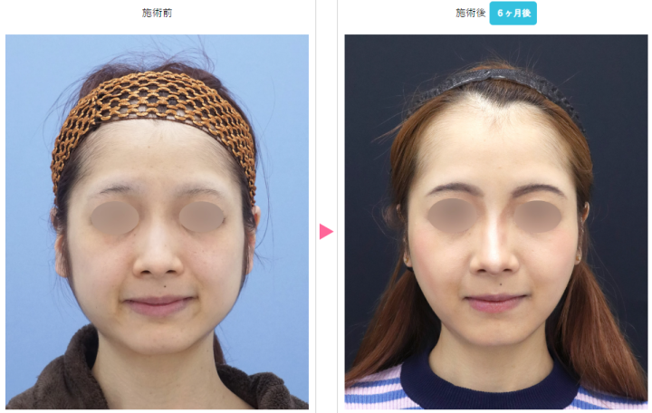 湘南美容クリニック_症例写真_テスリフト