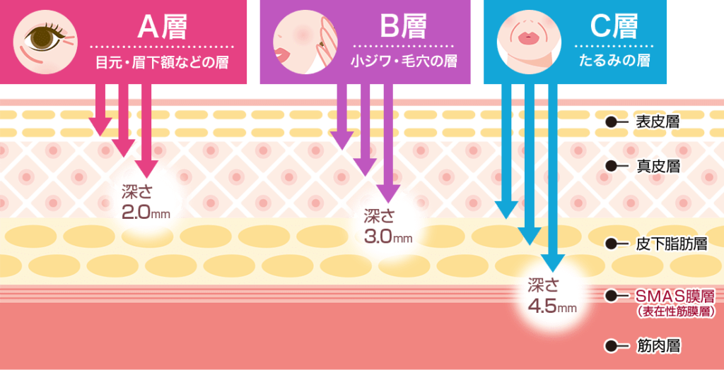 品川美容外科_ソノクイーン