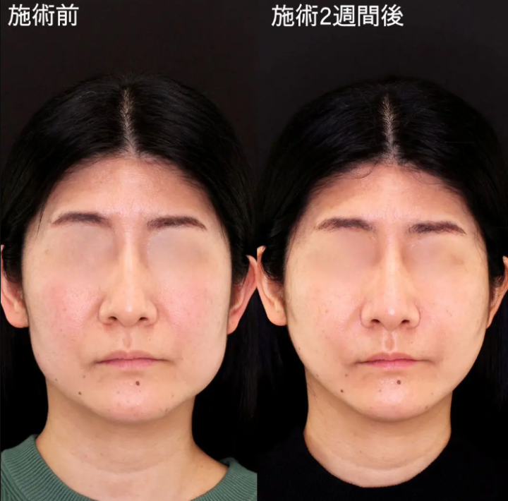TAクリニック 症例写真_ほうれい線