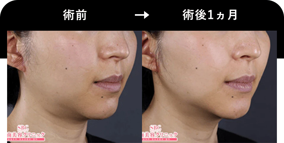 湘南美容クリニック_ハイフ_症例写真