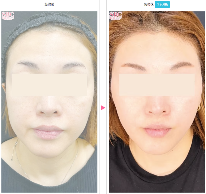 湘南美容クリニック_プリマリフト_症例写真
