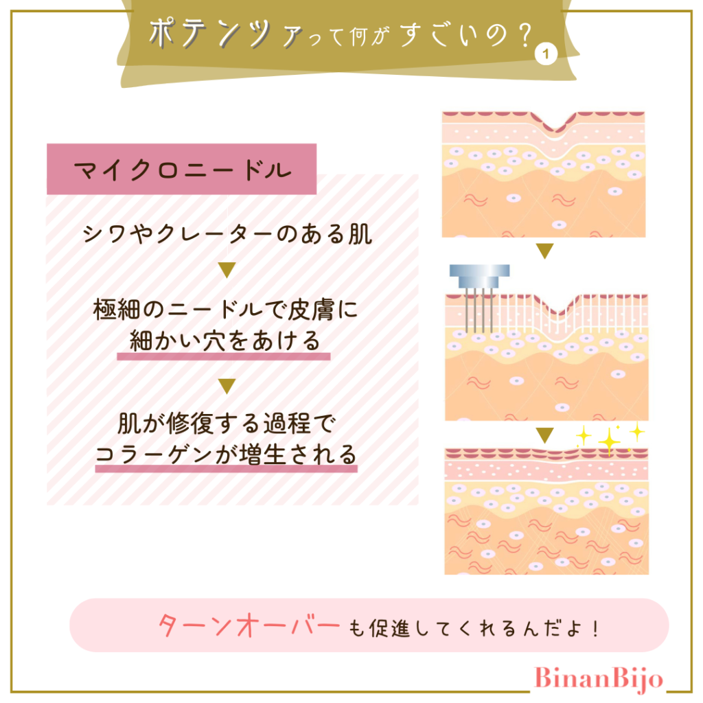 ポテンツァとは1【マイクロニードル】
