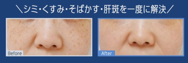 TCB ピコトーニング