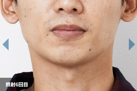 照射6回目