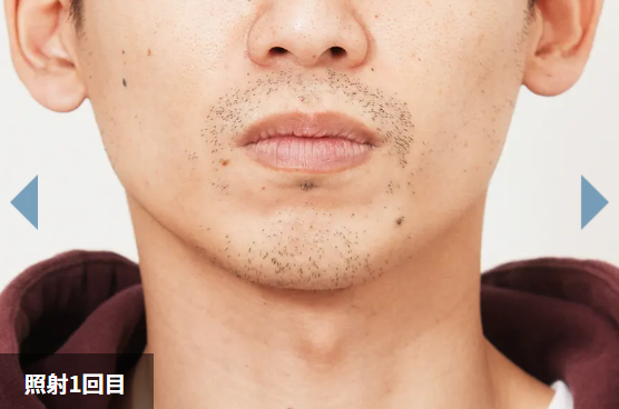 照射1回目