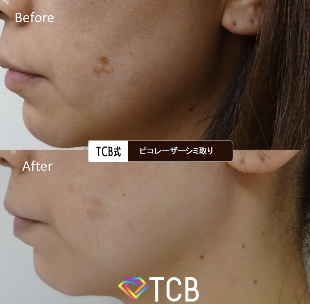 TCB東京中央美容外科 シミ取り