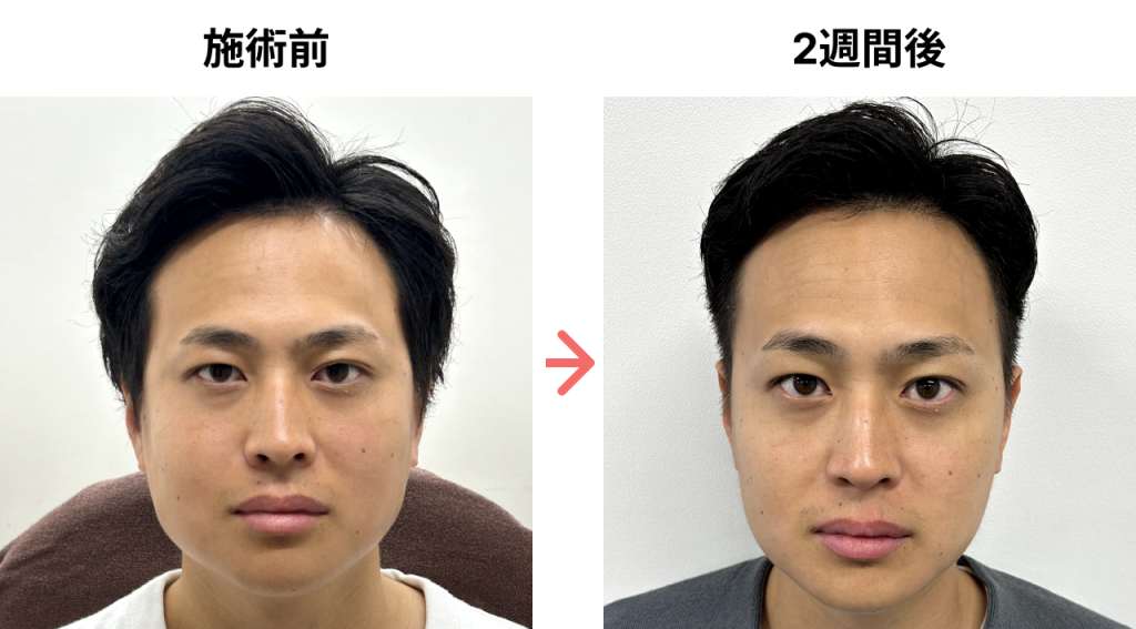 エラボトックス症例_大塚