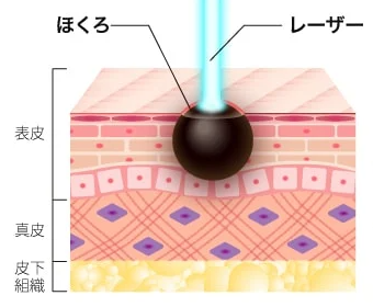 ほくろ除去レーザー