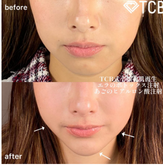 TCB東京中央美容外科 エラボトックス症例