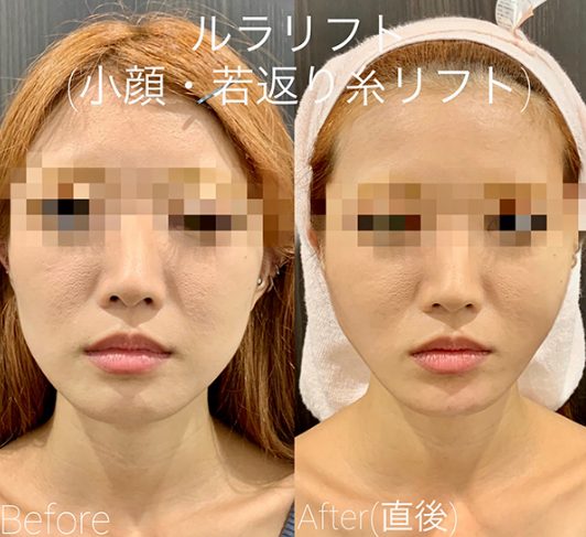ルラ 糸リフト症例