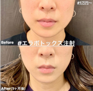 ルラ美容クリニック エラボトックス症例