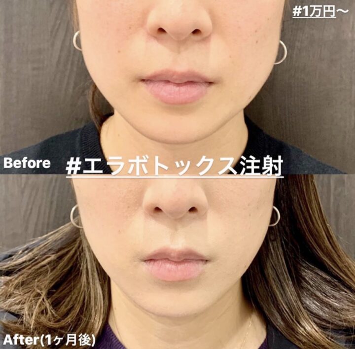 ルラ美容クリニック　エラボトックス