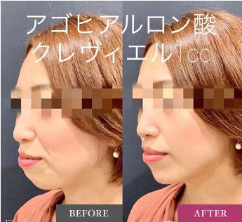 ルラ美容クリニック ヒアルロン酸症例