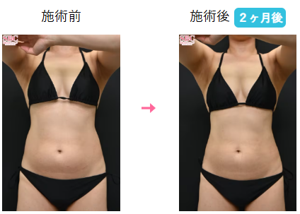 湘南美容クリニック クールスカルプティング症