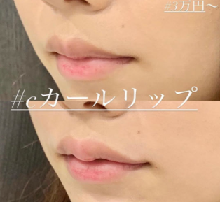 ルラ美容クリニック Cカールリップ症例