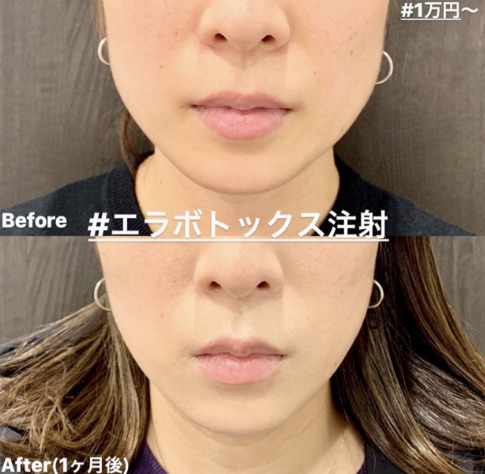 ルラ美容クリニック ボトックス