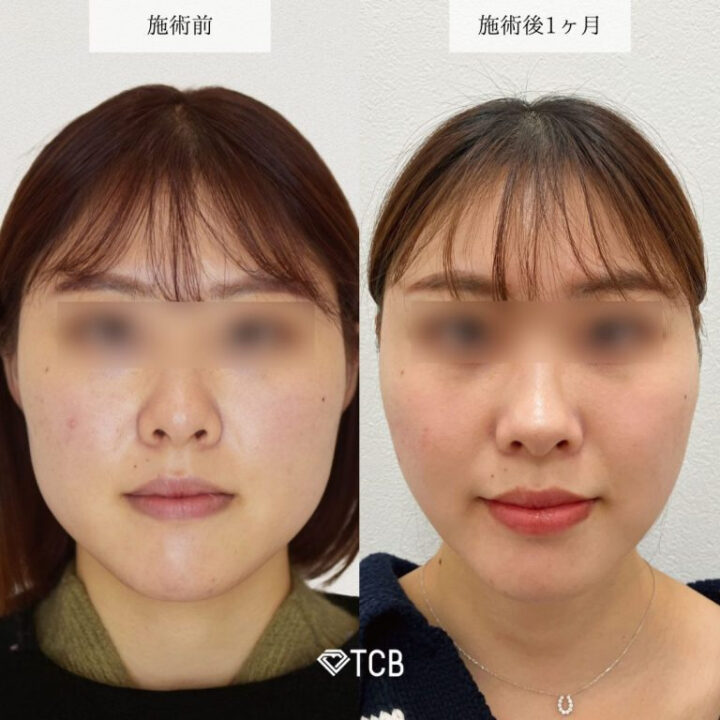 TCB東京中央美容外科　エラボトックス