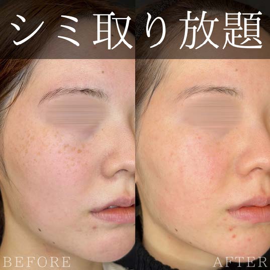 ルラ美容クリニック シミ取りの症例写真