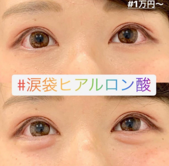 ルラ美容クリニック ヒアルロン酸症例