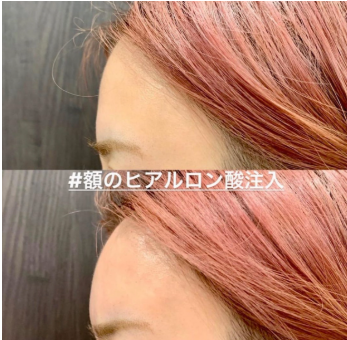 ルラ美容クリニック ヒアルロン酸