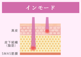 ルラ美容クリニック インモード
