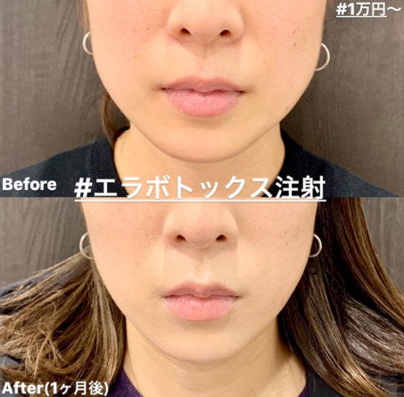 ルラ美容クリニック　エラボトックス