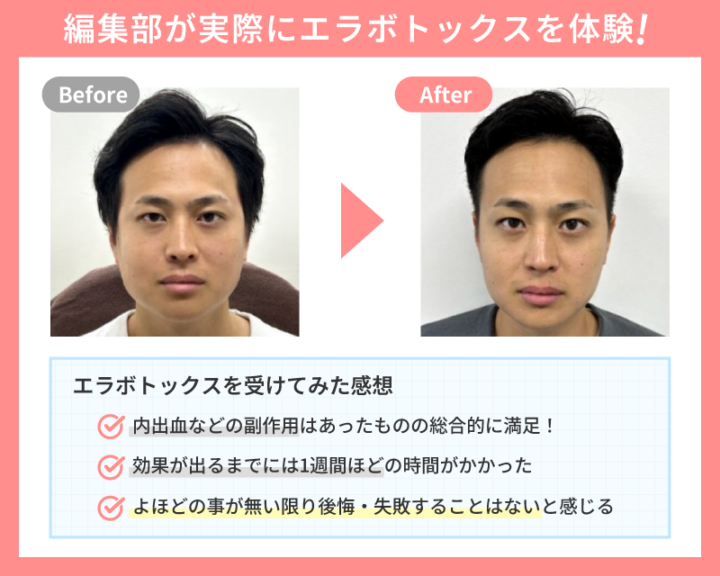 エラボトックス 後悔 症例