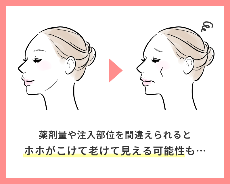 エラボトックス 後悔