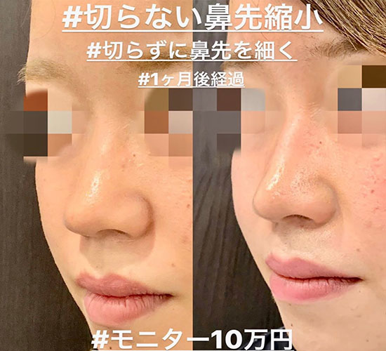 ルラ美容クリニック 小鼻縮小