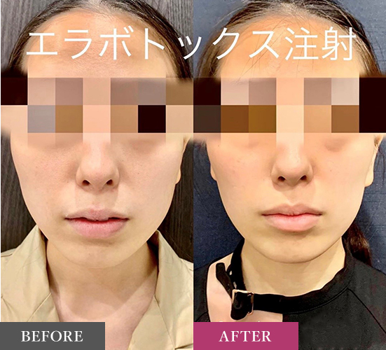 ルラ美容クリニック エラボトックス