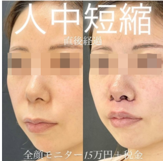 ルラ美容クリニック 人中短縮手術