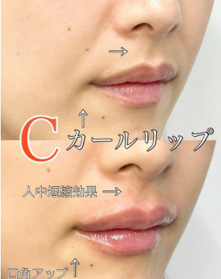 ルラ美容クリニック Cカールリップ症例