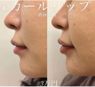 ルラ美容クリニック Cカールリップ症例
