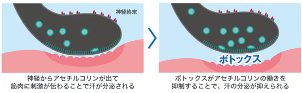 湘南美容クリニック 郡山院 脇ボトックス