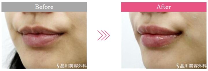 品川美容外科 唇ヒアルロン酸